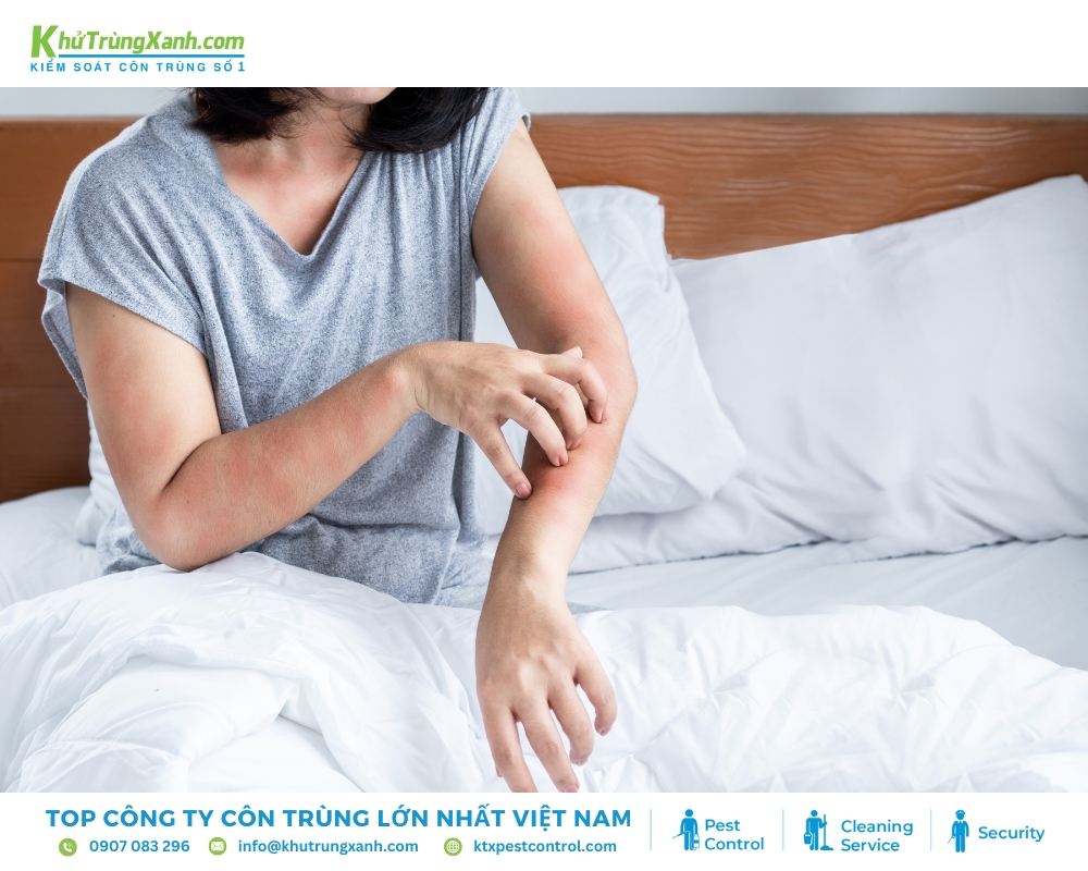 Rệp giường gây ra những vết cắn sưng đỏ và ngứa ngáy
